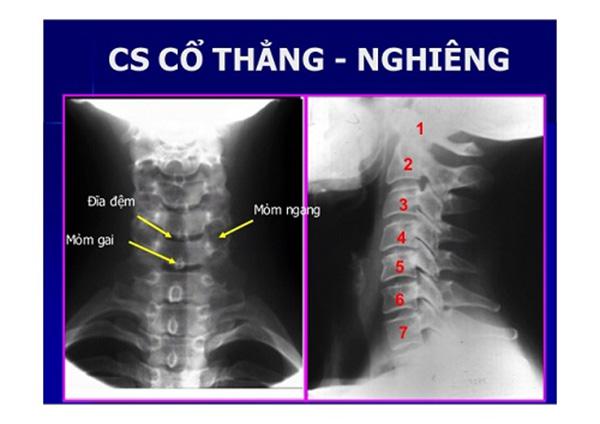 Tê liệt tay vì thoái hóa cột sống cổ - người trẻ cũng không được chủ quan! - 2