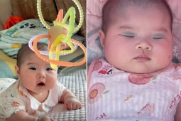 Bạn trẻ - Cuộc sống - Em bé có vết bớt hiếm gặp, giống như bé biết trang điểm từ trong bụng mẹ