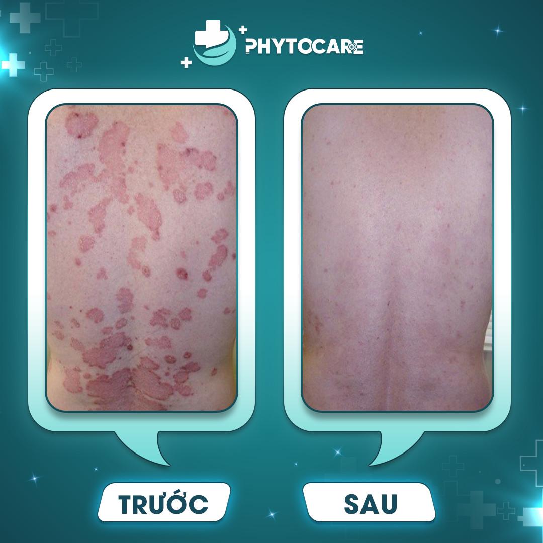 Đánh giá hiệu quả điều trị vảy nến tại Phòng khám da liễu Phytocare Hà Nội - 3