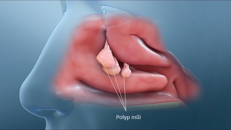 Nghẹt mũi một bên luân phiên kéo dài - Dấu hiệu nhiều bệnh lý mũi xoang nghiêm trọng - 2