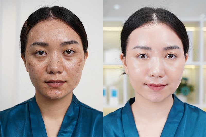 Kết quả sau cấy Meso Extra do bác sĩ Đào Xuân Hưởng điều trị