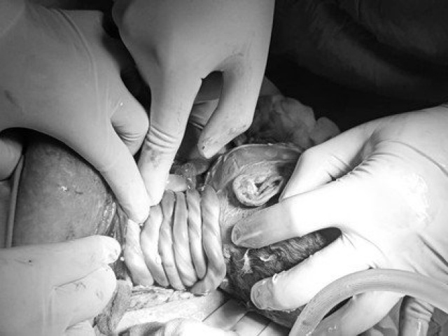 Sức khỏe đời sống - Thai nhi 34 tuần bị dây rốn quấn đến 6 vòng quanh cổ