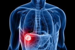 Sức khỏe đời sống - 6 dấu hiệu cảnh báo ung thư gan nhiều người bỏ sót