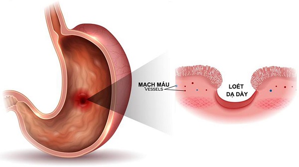 Viêm loét dạ dày (Ảnh minh họa)