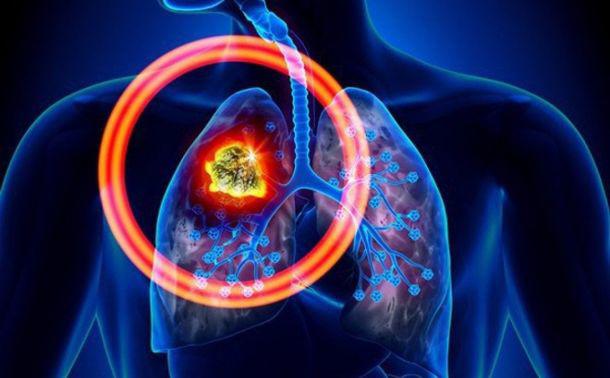 5 dấu hiệu cảnh báo ung thư phổi dễ bị nhầm lẫn với bệnh khác, cần hết sức cảnh giác - 1