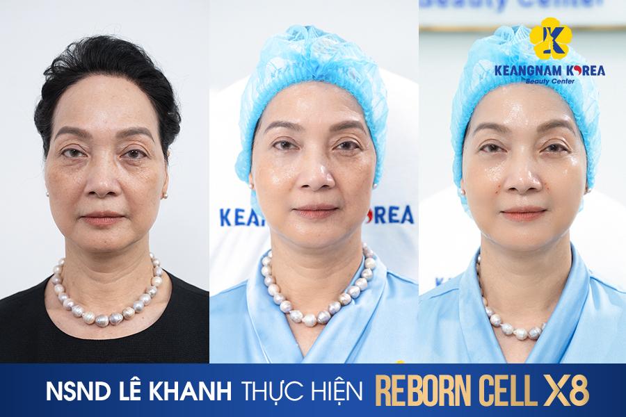 Công nghệ trẻ hóa da Reborn Cell X8