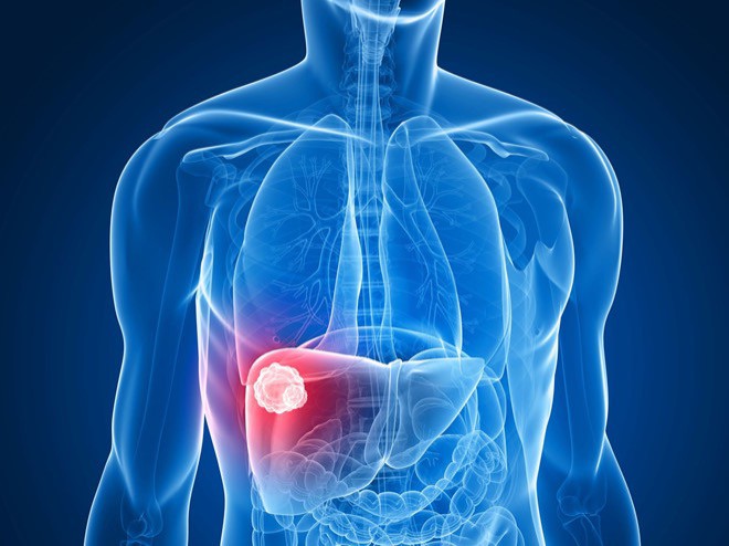 Ung thư gan là ung thư đứng đầu tại Việt Nam, trong đó 90% số ca ung thư gan là ung thư biểu mô tế bào gan.