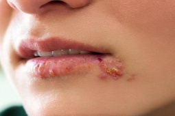 Sức khỏe đời sống - Người đàn ông bị loét toàn bộ “cậu nhỏ” vì lý do này