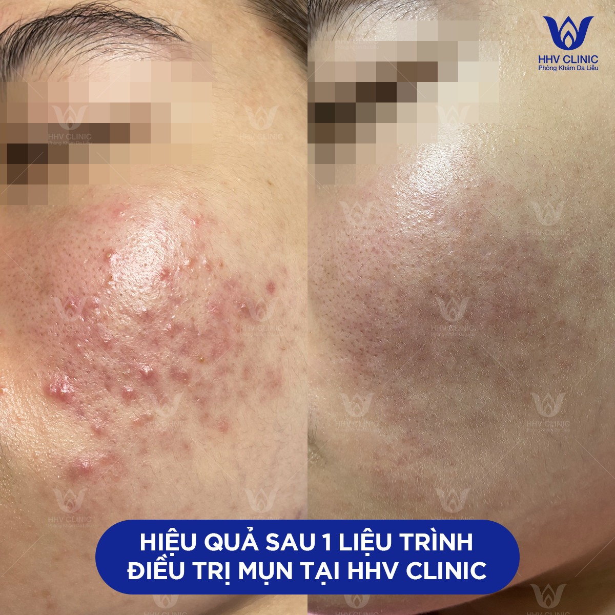 Khách hàng tin tưởng điều trị mụn tại Phòng khám da liễu HHV Clinic