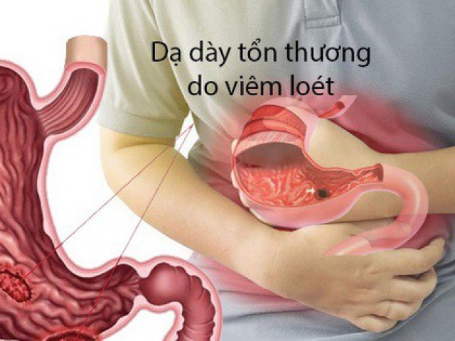 Ai bị đau dạ dày cần biết điều này, 5 thực phẩm nên ăn để phòng các cơn đau tái phát