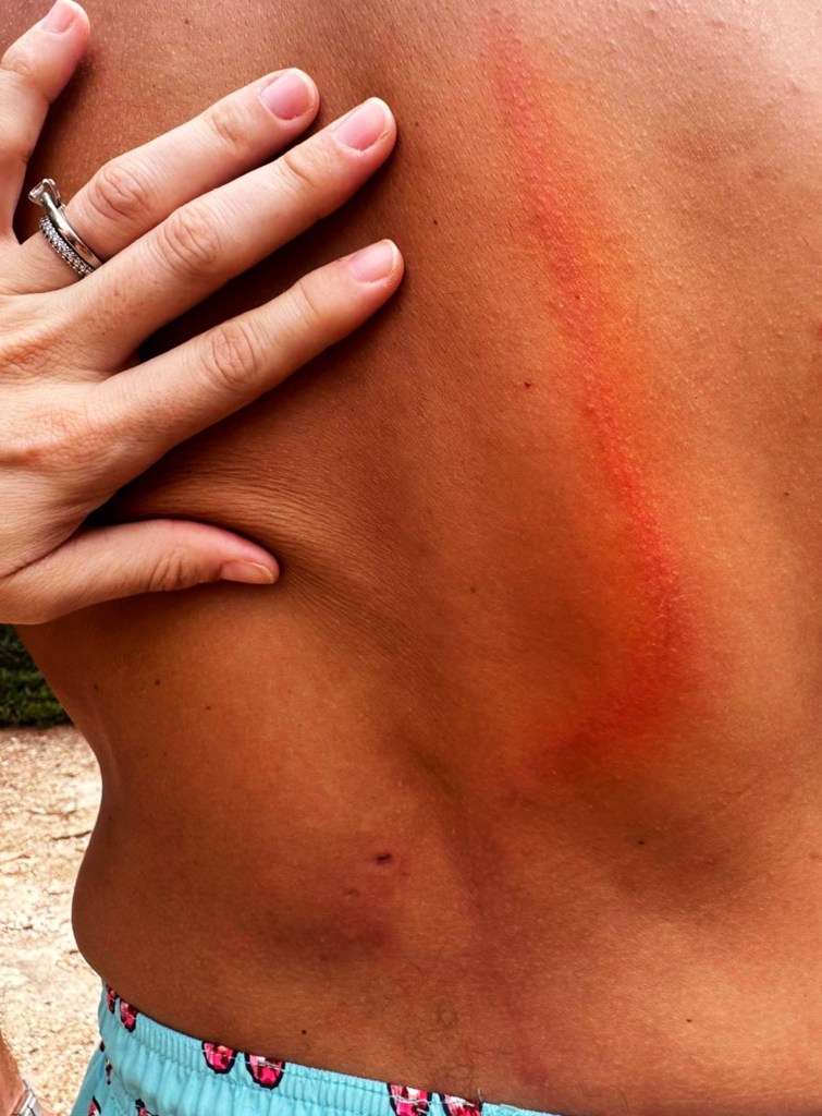 Triacca bị gãy vài xương sườn trong cuộc tấn công.