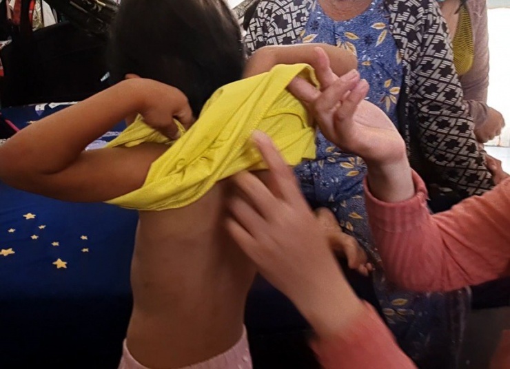 Tình nguyện viên của xã Tân Trung đang xem xét các vết thương trên người bé Nhã Thi. Ảnh: TRẦN VŨ