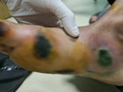 Bệnh nhân đái tháo đường loét bàn chân do thói quen thường gặp