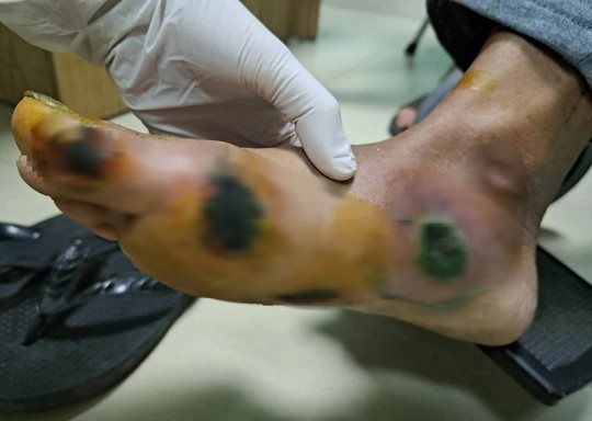 Nam bệnh nhân bị loét bàn chân do biến chứng đái tháo đường. Ảnh: Bệnh viện cung cấp