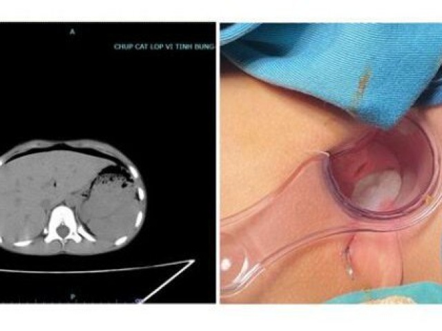 Sức khỏe đời sống - Bé 8 tuổi thủng trực tràng vì ngồi vào chiếc bút do bạn dựng ngược