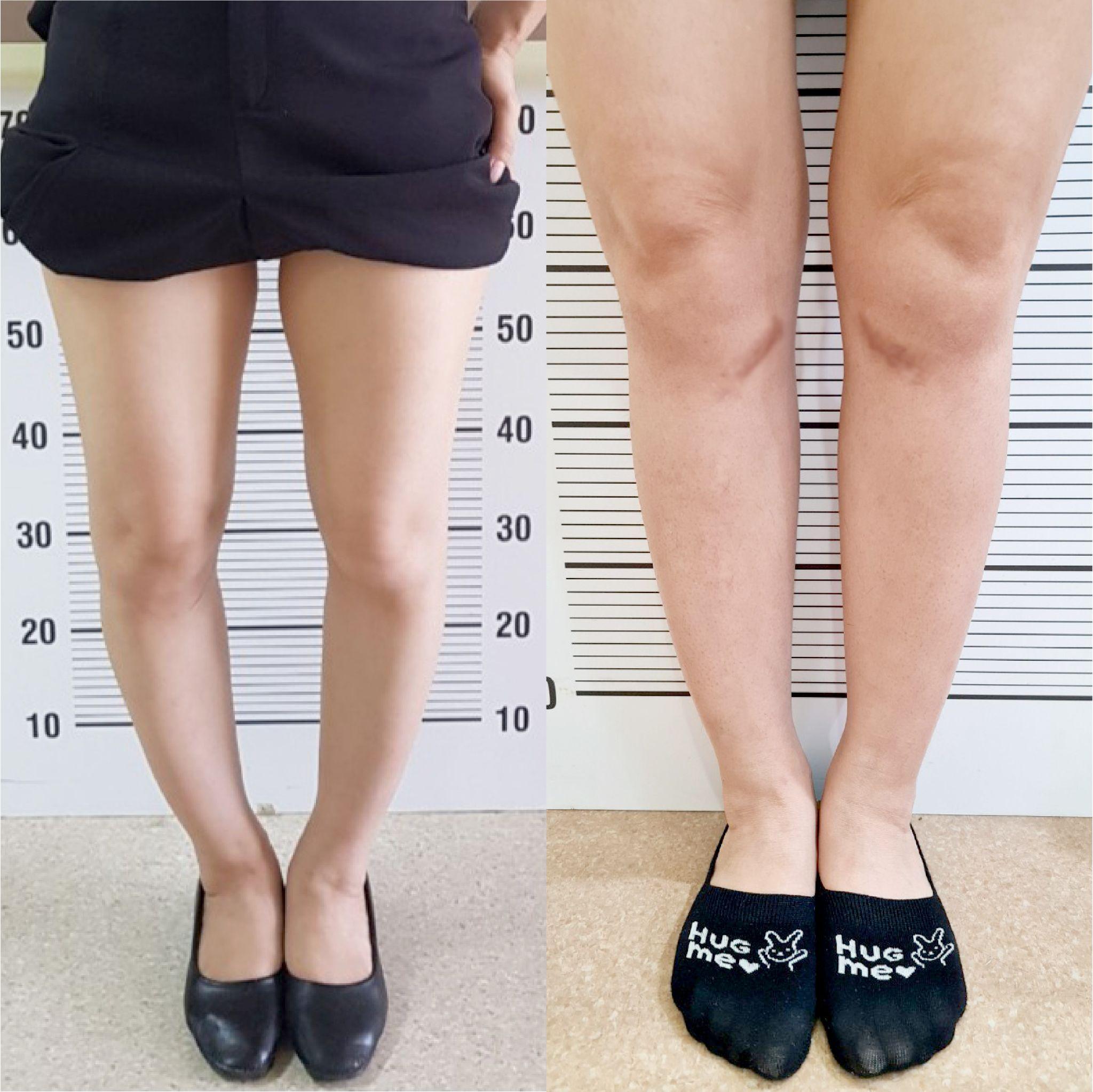 Tình trạng chân vòng kiềng của nữ bệnh nhân đã được cải thiện sau khi phẫu thuật