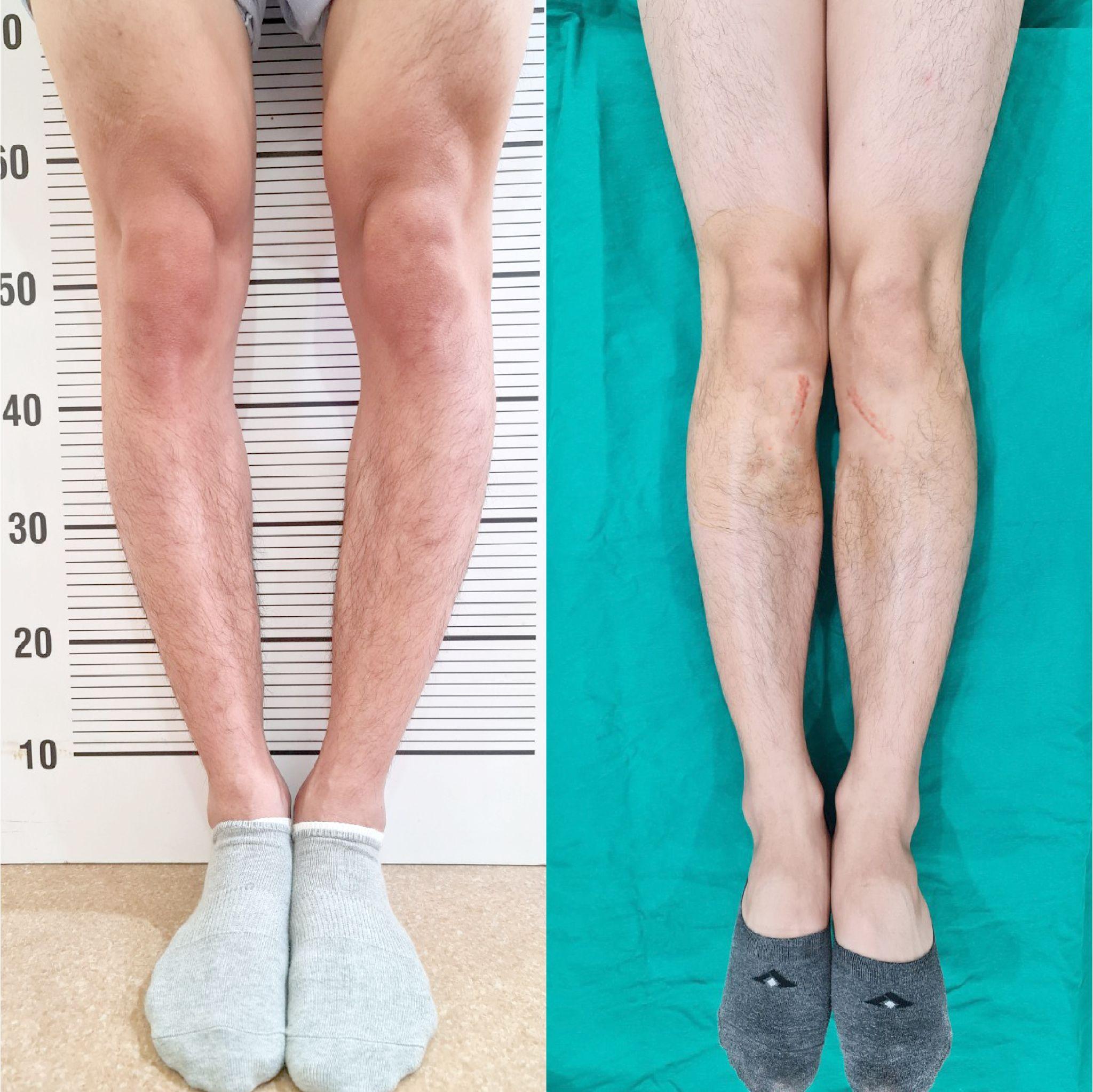 Sự cải thiện có thể nhìn thấy ngay sau ca phẫu thuật chân vòng kiềng