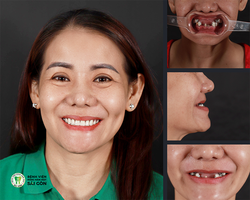 Nụ cười tự nhiên sau khi trồng răng cũng là điều cần lưu ý khi trồng răng All on 4