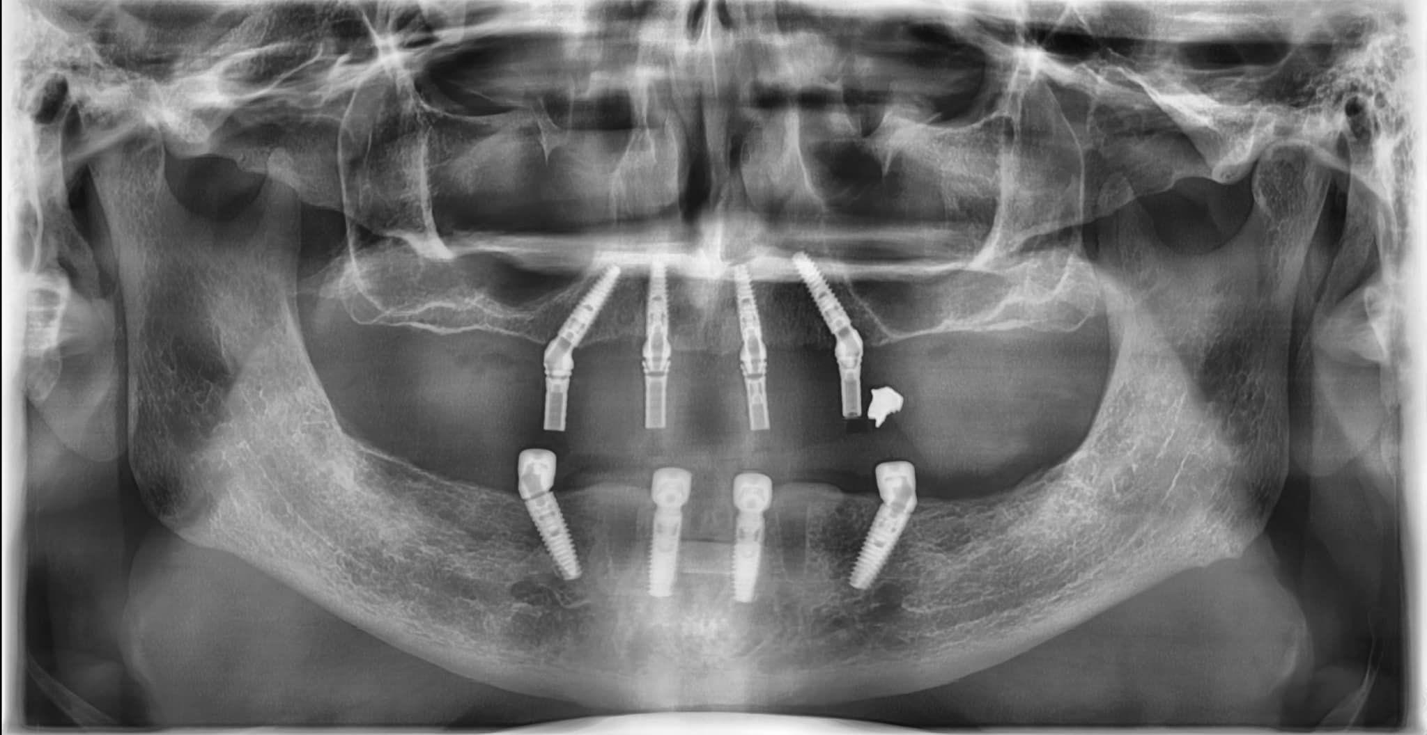 Phương pháp All on 4 chỉ sử dụng 4 trụ để nâng đỡ toàn hàm răng