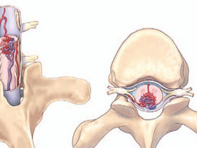 Sức khỏe đời sống - Bệnh nhân đột ngột liệt nửa người, bác sĩ phát hiện bệnh rất hiếm gặp