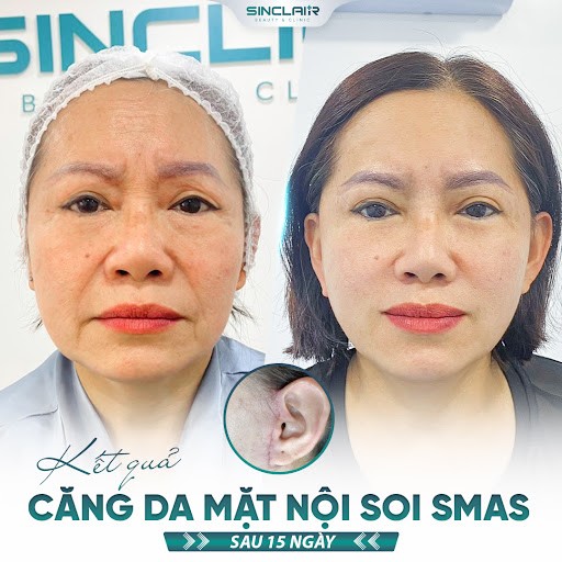 Kết quả căng da nội soi Smas của khách hàng tại Sinclair.