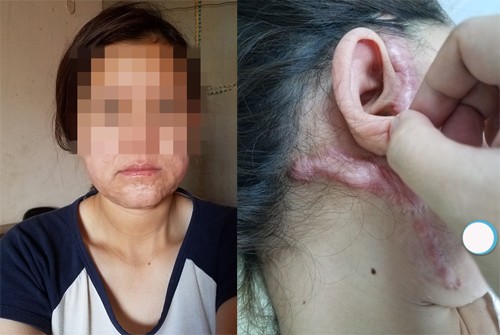 Biến chứng khi căng da mặt tại cơ sở kém uy tín (ảnh minh họa).