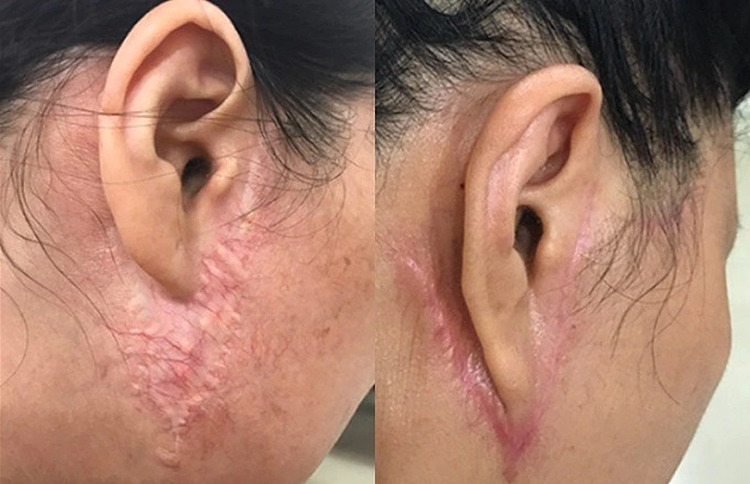 Sẹo xấu sau khi căng da mặt tại cơ sở kém uy tín (ảnh minh họa).