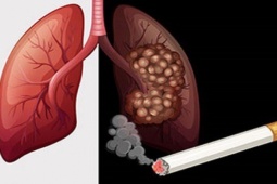 Sức khỏe đời sống - Ai có nguy cơ mắc loại ung thư phổ biến đứng thứ 2 ở nam giới?