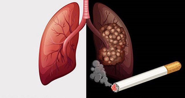 Thuốc là là một trong những nguyên nhân gây ung thư phổi.&nbsp;