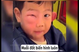 Clip hài hước - "Dở khóc dở cười" khi trẻ bị muỗi đốt