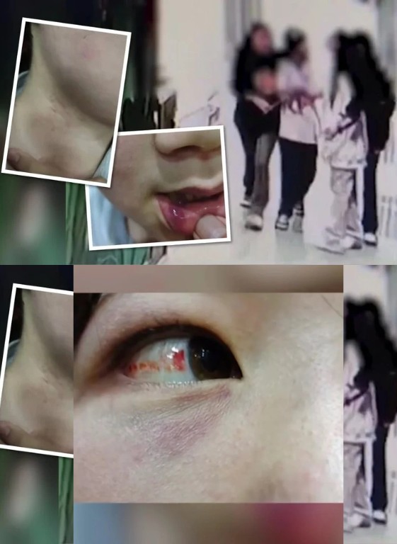 Cô bé 14 tuổi bị đa chấn thương, bao gồm cả tổn thương ở mắt. Ảnh: SCMP