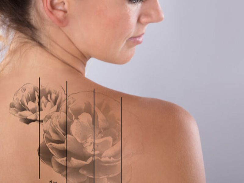 Xóa xăm vĩnh viễn có đau không?