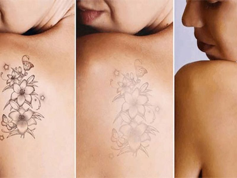 Hiệu quả của xóa xăm bằng laser