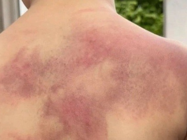 Pháp luật - Đồng Nai: Khởi tố người cha hành hạ con trai 5 tuổi dã man