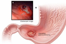 Sức khỏe đời sống - Phó Giám đốc Bệnh viện K chỉ rõ dấu hiệu cảnh báo sớm ung thư dạ dày