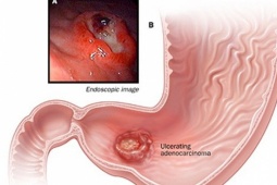 Sức khỏe đời sống - Phó Giám đốc Bệnh viện K chỉ rõ dấu hiệu cảnh báo sớm ung thư dạ dày