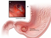 Sức khỏe đời sống - Phó Giám đốc Bệnh viện K chỉ rõ dấu hiệu cảnh báo sớm ung thư dạ dày