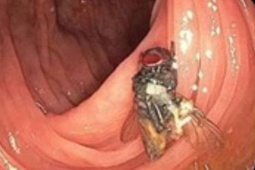 Sức khỏe đời sống - Bác sĩ phát hiện con ruồi còn nguyên vẹn khi nội soi đại tràng bệnh nhân
