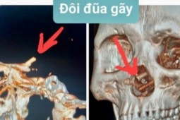 Sức khỏe - Đôi đũa nằm trong hộp sọ 5 tháng mà bệnh nhân không hề biết