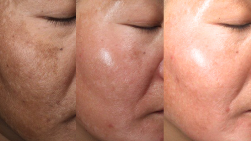 Ứng dụng Picosure Pro trong điều trị nám - trẻ hóa tại DRH Clinic