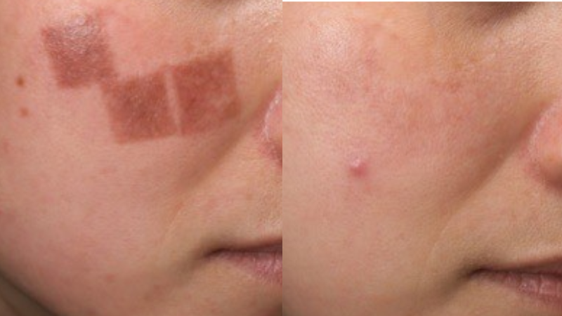 Một trường hợp điều trị nám biến chứng (do laser sai cách) tại DRH Clinic
