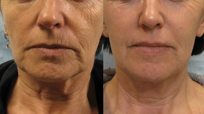 Hình ảnh điều trị thực tế từ khách hàng trải nghiệm 03 lần Mezo Pro