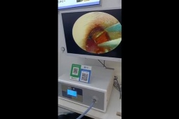 Phi thường - kỳ quặc - Clip: Thấy khó chịu trong tai, người đàn ông đi kiểm tra phát hiện "dị vật đáng sợ"