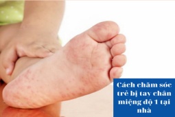 Cách chăm sóc trẻ bị bệnh tay chân miệng độ 1 tại nhà mẹ nên tham khảo