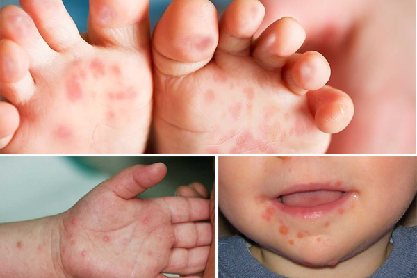 Trẻ bị tay chân miệng độ 1 cần được chăm sóc và theo dõi cẩn thận tại nhà
