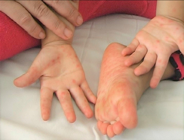 Bệnh tay chân miệng độ 1 là giai đoạn đầu của bệnh
