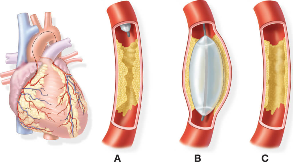 Đặt stent để điều trị bệnh mạch vành, phòng suy tim