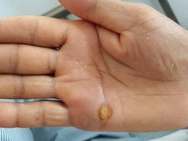 Sức khỏe đời sống - Đã có 3 ca tử vong do uốn ván ở Hà Nội