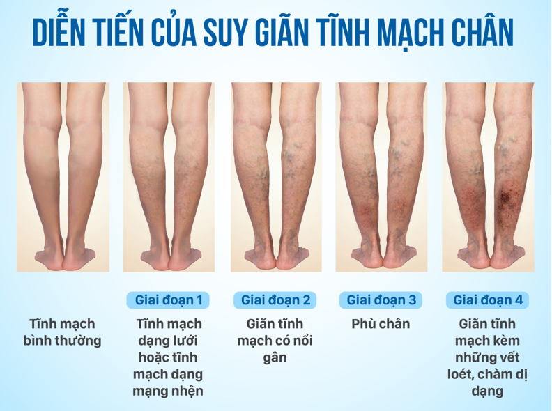 5 cây thuốc nam chữa suy giãn tĩnh mạch cực hiệu quả - 1