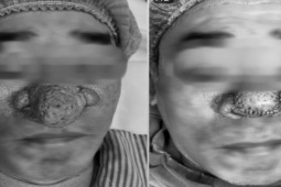 Sức khỏe đời sống - Cực kỳ hy hữu: Người đàn ông 50 tuổi mắc bệnh mũi sư tử